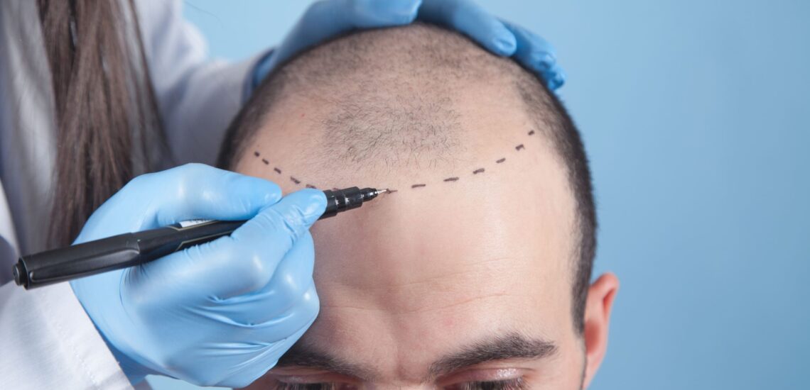 How We Helped A Hair Transplant Clinic Generate 500 Patients In A Year